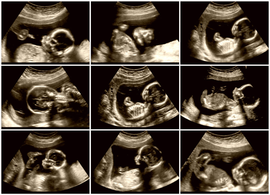 Nine images of fetus ultrasonography.